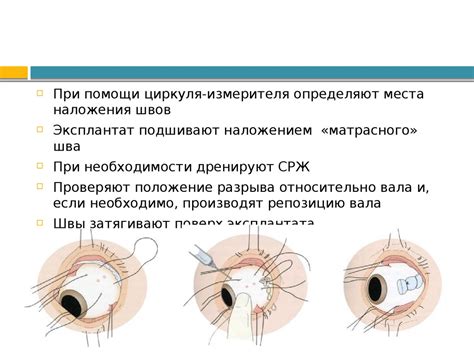 Отслойка сетчатки - презентация онлайн