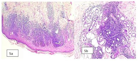A And 5b Discoid Lupus Erythromatosis 5a Shows H And E Stain Under 4x