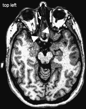 Olfactory Nerve Mri