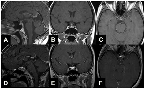 Brain Sciences Free Full Text Endoscopic Endonasal Transplanum