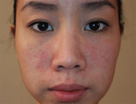 Allergic Reaction Rash On Face Swollen Eyes Printable Templates Protal
