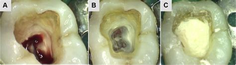 Complete Pulpotomy Procedure A Access Opening And Removal Of The