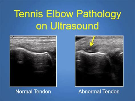 Lateral Epicondylitis Radiology