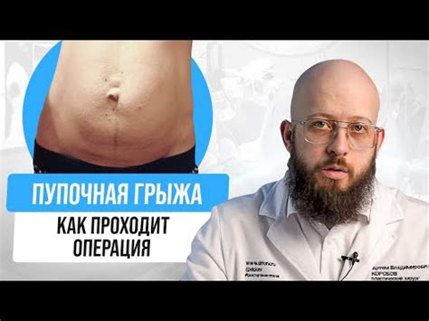 Операция по удалению пупочной грыжи. Виды лечения пупочной грыжи. - YouTube