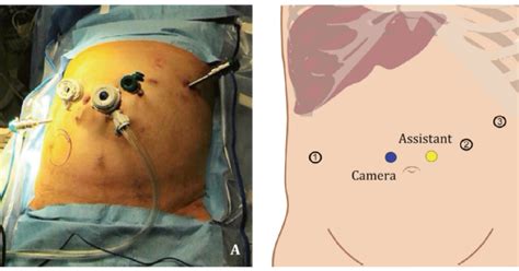 Robotic Assisted Placement Of Hepatic Artery Infusion Pump For The Treatment Of Colorectal Liver