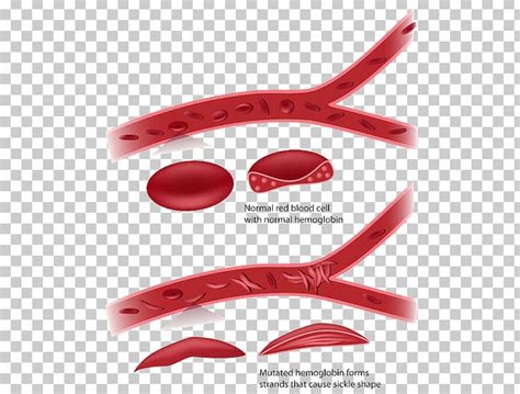 Sickle Cell Disease Red Blood Cell Anemia Png Clipart Anemia Blood