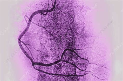 Right coronary artery, angiogram - Stock Image - C055/4976 - Science ...