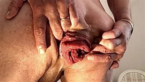 Demonstration Dilatation Anal XHamster