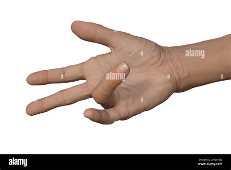 Dupuytrens Contracture Illustration Stock Photo Alamy
