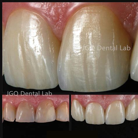 Dental Laminates Ceramic Zirconia Crown Dentures Aesthetic Restoration