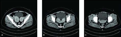 Ct Findings Of The Uterus A Ct Shows Bilateral Enlargement Of The