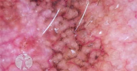 Annular Granular Pattern And Rhomboids Seen In Dermoscopy Of Lentigo