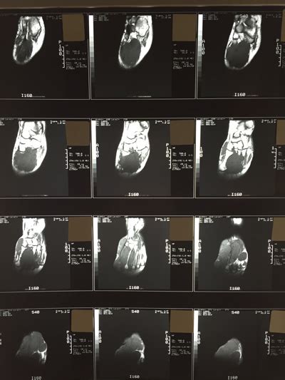 Foot Muscles Mri : Foot Muscles Mri / Baxter S Nerve First Branch Of ...