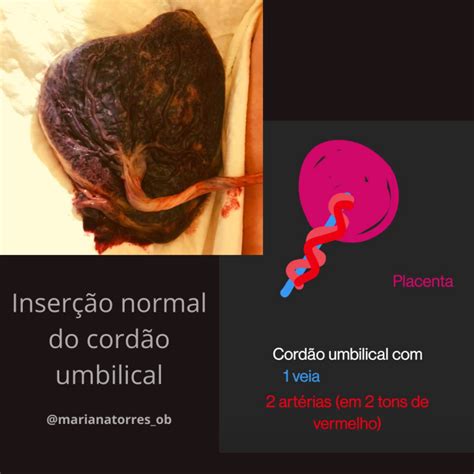 No Cordao Umbilical Sao Encontrados