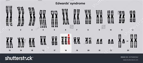 Sindrome De Edwards Foto - 123 Sindrome di edwards: immagini, foto stock e grafica vettoriale ...