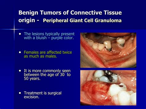 Ppt Benign Tumors Of The Oral Cavity Powerpoint Presentation Free