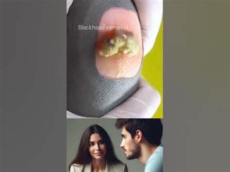 어쭈?? Goodbye Blackhead removal video clip#blackhead,#블랙헤드,#pimple ...