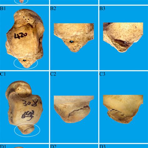 Fracture Of Posterior Process Of Talus Overall Front And Reverse