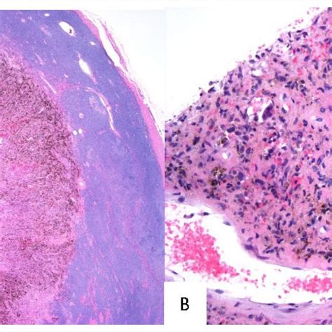 A Phosphaturic Mesenchymal Tumor Resection Showing Striking Dimorphism