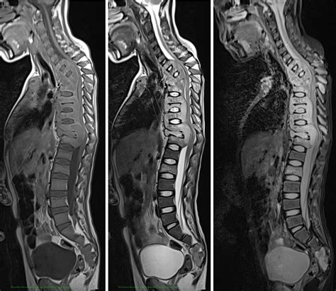 Disseminated tuberculosis – Radiology Cases