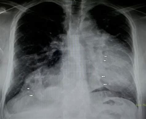 A Heart Between 2 Swords - Journal of Cardiothoracic and Vascular ...