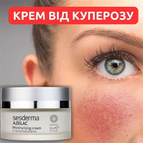 КУПЕРОЗ - Причини - Симптоми - Профілактика - Лікування