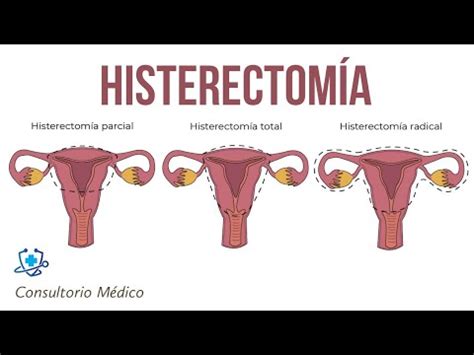 Histerectom A Tipos De Histerectom A Por Qu Se Hace Una