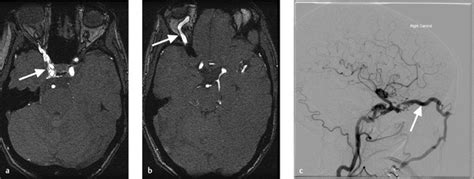 5 Cerebral Arteriovenous Malformations Avms And Dural Arteriovenous Fistulas Davfs