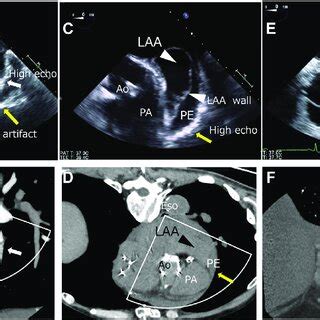 Two Dimensional Upper Esophageal Transesophageal Echocardiographic