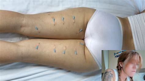 Free Needle Porn Videos XHamster