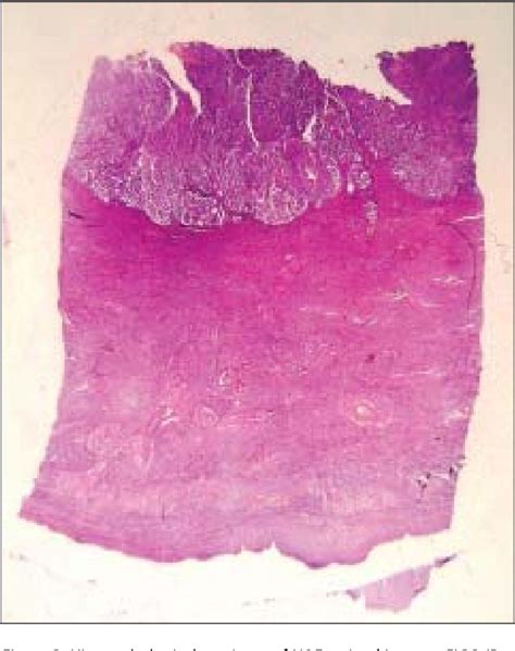 Figure 3 From Value Of The Intraoperative Assessment Of The Depth Of