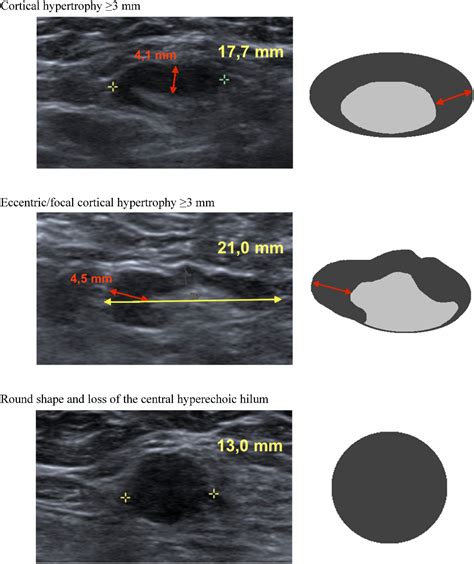 Diagnostic Accuracy Of Axillary Staging By Ultrasound In Early Breast Cancer Patients European