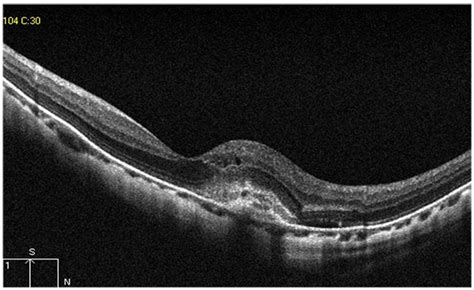 Assessment Of Posterior Segment Using Spectral Domain Oct In Highly