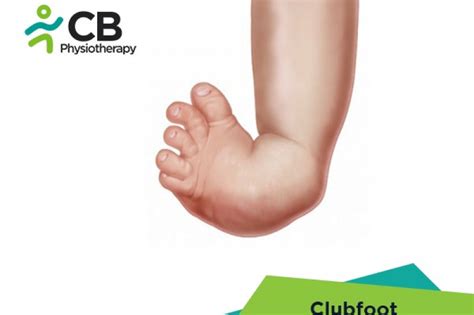 Top 5 Exercises For Clubfoot Or Congenital Talipeswebp