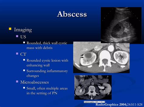 Renal Inflammatory Disease Ppt