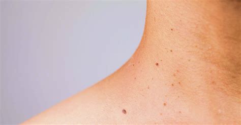 Skin Tag vs. Wart: Understanding the Difference – Skintify