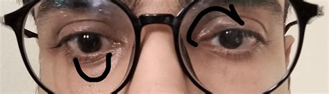 Could This Small Chalazion Be Treated With Warm Compression Or Could
