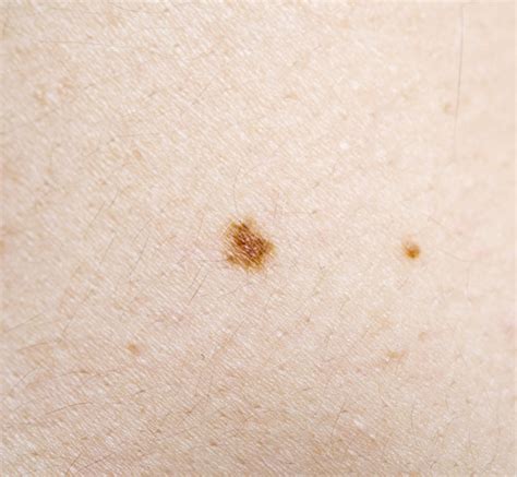 Melanoma El C Ncer M S Agresivo Experta