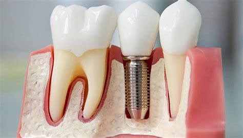 зубные импланты | Implantes dentarios, Odontologo, Ligas