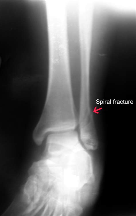 Spiral Fractures :: Bone Fracture & Repair