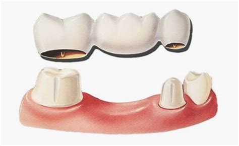 dental bridge   works   advantages  offers