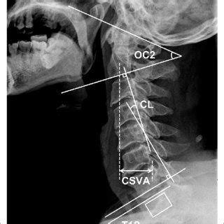 Comparison Of Cervical Sagittal Parameters And Patient Reported