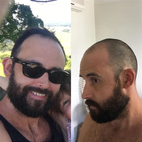 Bald Reddit Group. Lots Of Interesting Threads. | HairLossTalk Forums