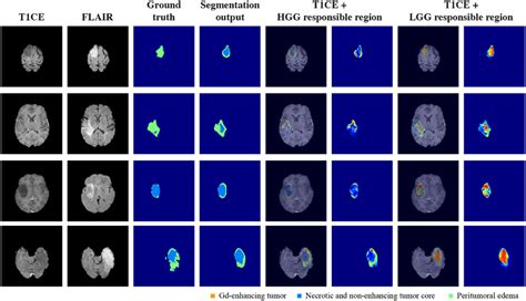 Example Results For Responsible Regions In Lgg Patients For Patients