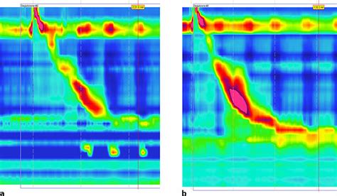 High Resolution Manometry Findings Before A And 1 Year After B Linx