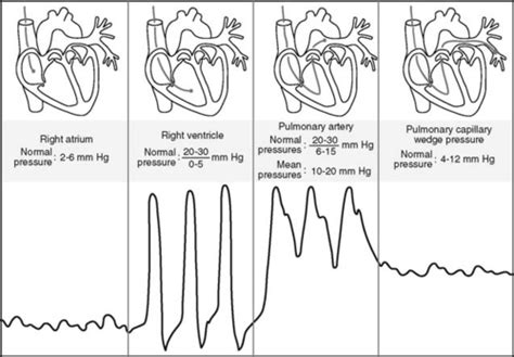 Hemodynamic Monitoring Ccrn Flashcards Quizlet