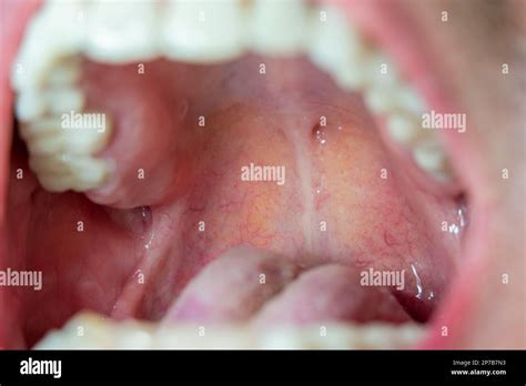 Back Of The Throat Roof Of The Mouth Macro Close Up View Of Caucasian