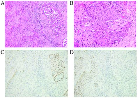 Hematoxylin And Eosin Staining Of The Thyroid Tumor Showing A The