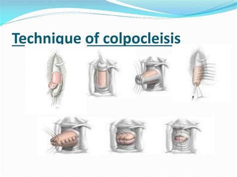 Ppt Outcome Of Colpocleisis A Ten Year Case Series Powerpoint