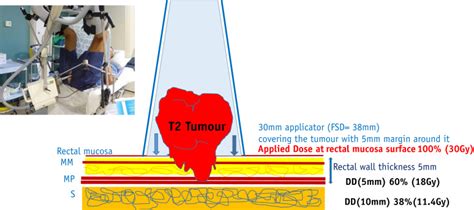 Dose Escalation Using Contact X Ray Brachytherapy After External Beam